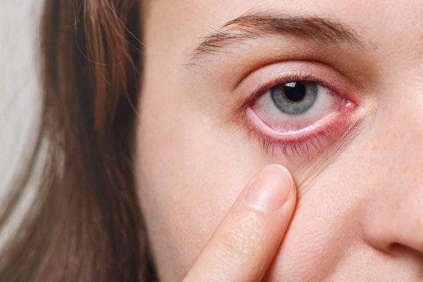 Giải đáp thắc mắc: Người bị bệnh đau mắt đỏ bao lâu thì khỏi?