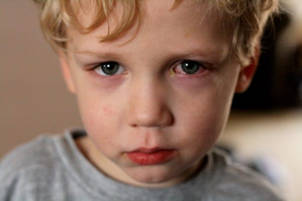 Khi trẻ bị đau mắt đỏ kiêng ăn gì để chóng khỏi?
